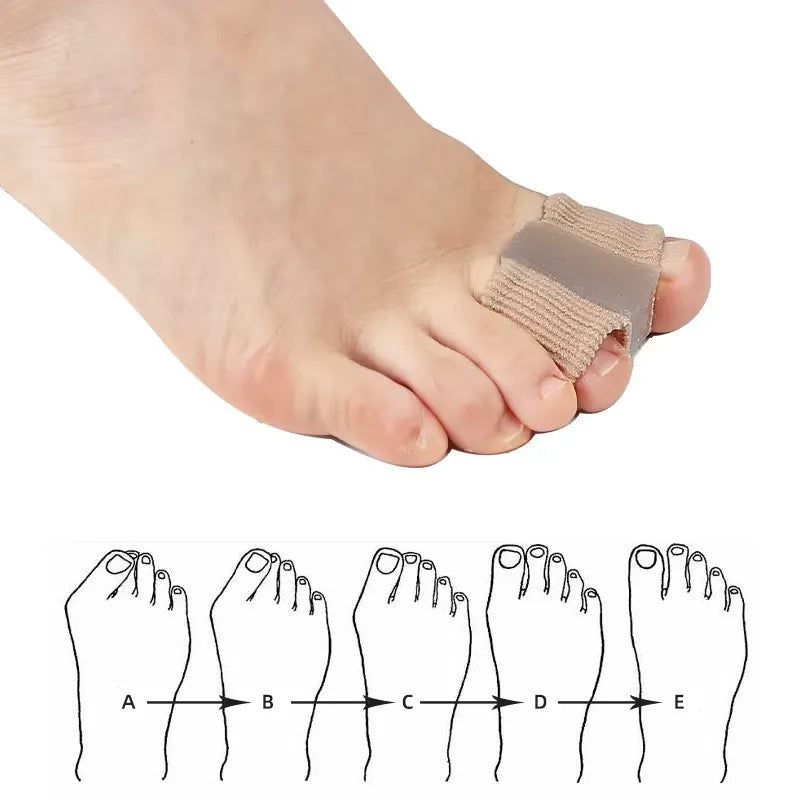 Toe correctors
